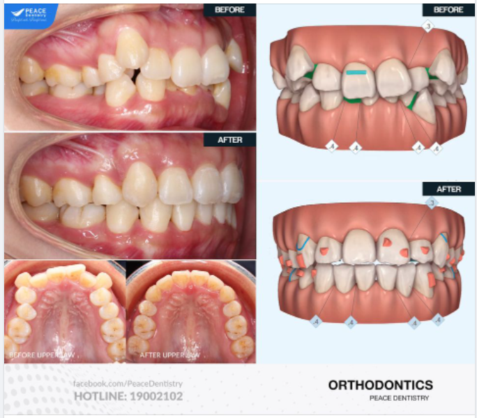 Ca lâm sàng -  Niềng răng Invisalign cho khách hàng 35 tuổi