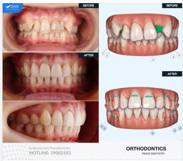 Ca lâm sàng Niềng răng Invisalign cho khách hàng 36 tuổi