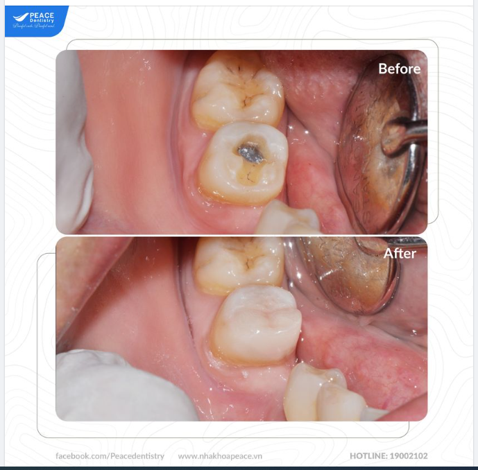 Ca lâm sàng Trám Sứ Onlay phục hồi mô răng, đáp ứng chức năng ăn nhai và thẩm mỹ