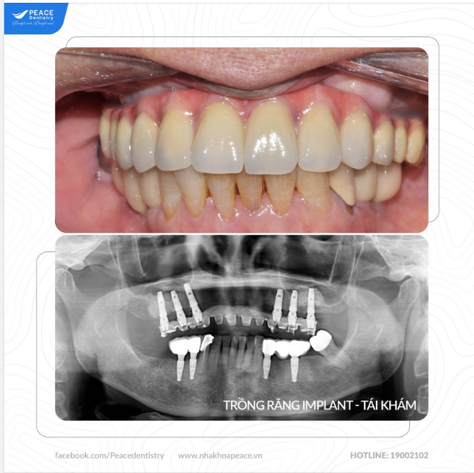 Ca lâm sàng  trồng răng Implant toàn hàm (All-on-6 Implant và hàm BioHPP) cho khách hàng lớn tuổi với những ghi nhận khi tái khám sau 3 năm: