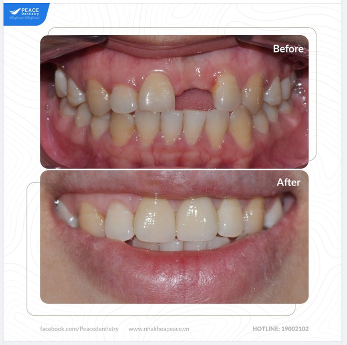 Ca lâm sàng trồng răng implant