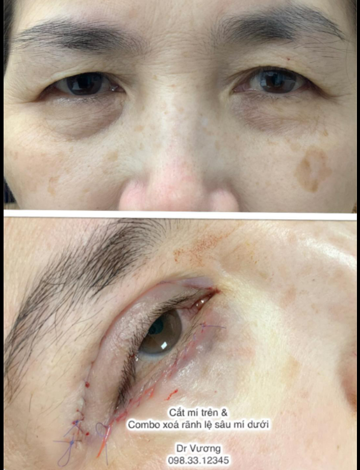 Ca mí của người lớn tuổi với Dr Vương