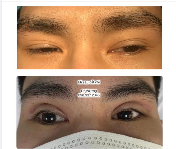 Ca mí Nam sau cắt chỉ đây các bạn ah, đã khá vào form rồi, giờ chỉ cần đợi vài bữa nữa cho ngót sưng hẳn đi là okie nhé !