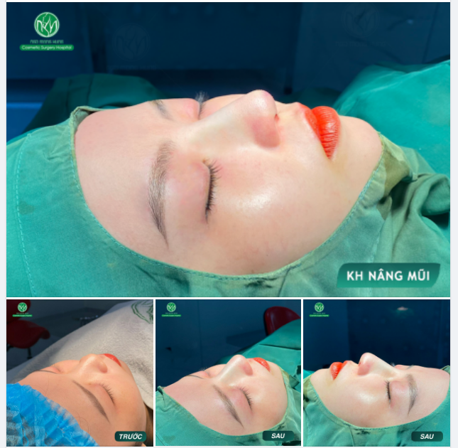 CA NÂNG MŨI CHÀO BUỔI SÁNG THỨ 4