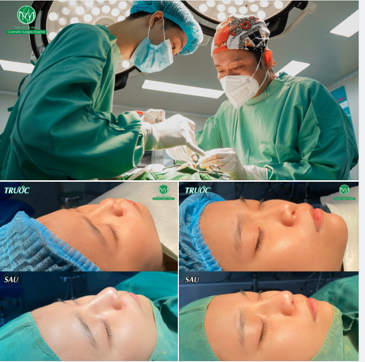 CA NÂNG MŨI MUỘN CUỐI NGÀY