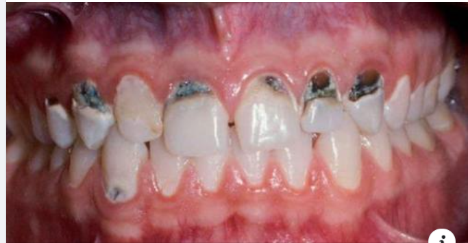 Các mảng bám nâu đen trên răng là biến thể nặng của vôi răng thông thường.