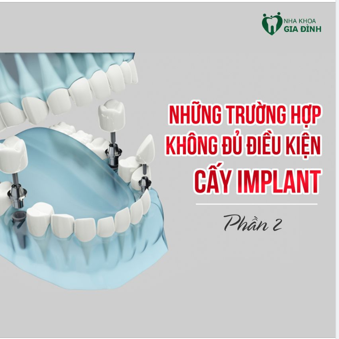 CÁC TRƯỜNG HỢP KHÔNG THỂ CẤY GHÉP IMPLANT 
