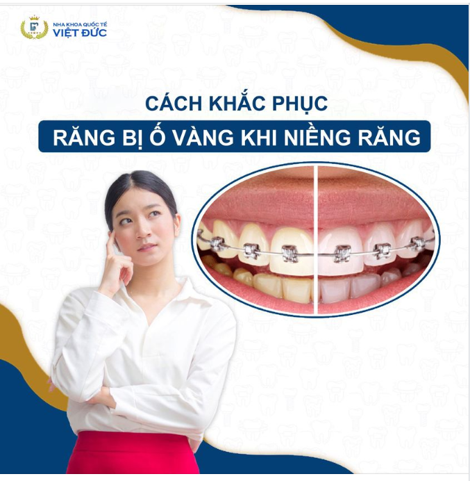 CÁCH KHẮC PHỤC RĂNG BỊ Ố VÀNG KHI NIỀNG RĂNG