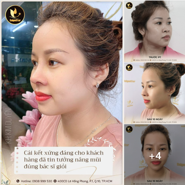 CÁI KẾT VIÊN MÃN SAU KHI NÂNG MŨI TẠI DR.HOẠT