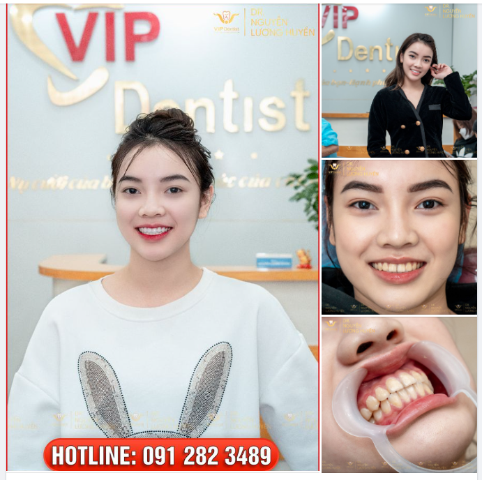 CẢI THIỆN HÌNH THỂ RĂNG, “HÔ BIẾN” ĐƯỜNG CƯỜI TRẮNG SÁNG VỚI HT SMILE