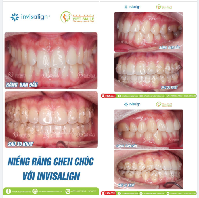 CẢI THIỆN RĂNG CHEN CHÚC VỚI INVISALIGN