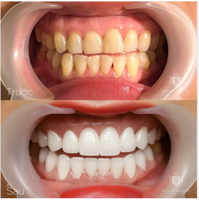 CẬN CẢNH BỘ RĂNG SỨ VỪA HOÀN THÀNH TẠI NHÀ SHINBI