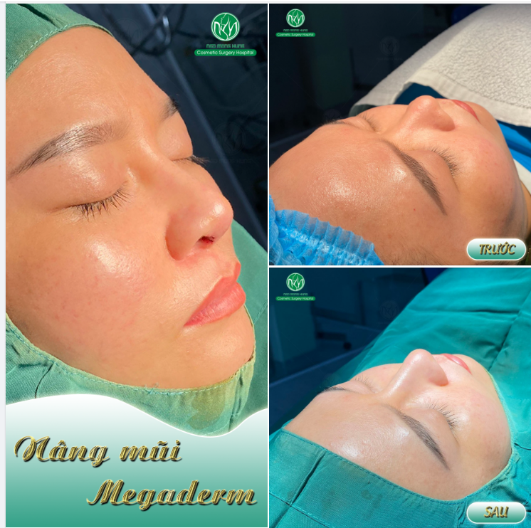 CẬN CẢNH DÁNG MŨI MEGADERM SAU THỰC HIỆN