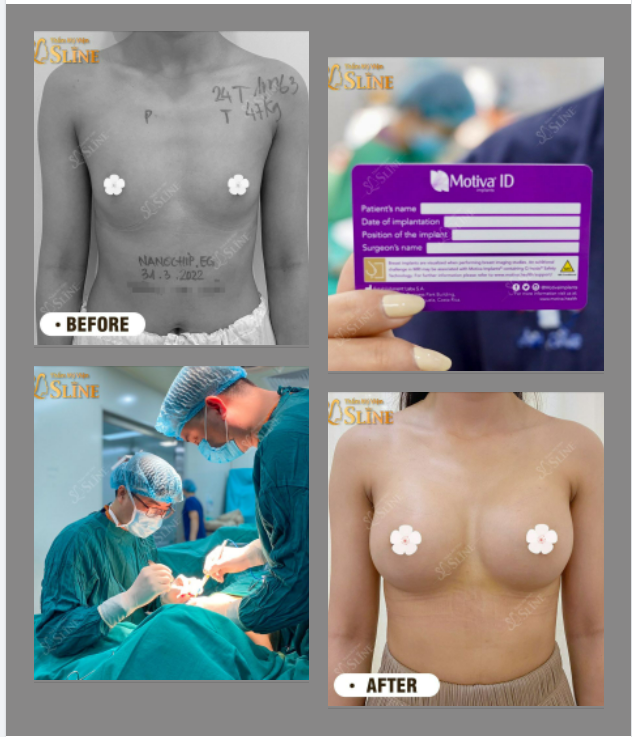 CẬN CẢNH Vòng 1 căng tròn sau 1 tháng nâng cấp với ekip Sline.