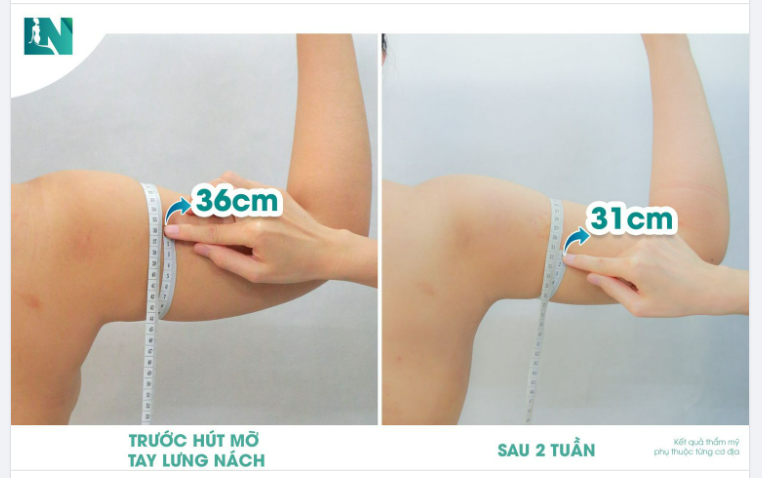 CÁNH TAY GỌN THON SAU 45 PHÚT, KHÓ NHƯNG KHÔNG KHÓ!