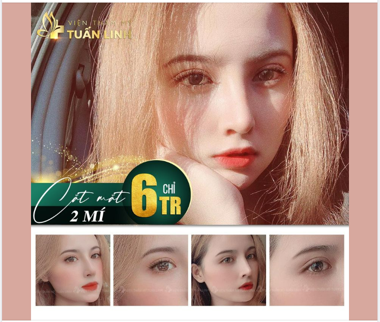 CẮT MẮT HAI MÍ - GIÁ CHỈ 6 TRIỆU.