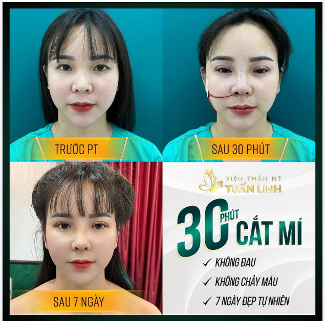 Cắt mí - 6 triệu - 7 ngày đẹp tự nhiên
