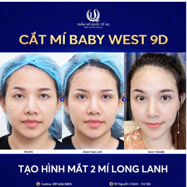 CẮT MÍ BABY WEST 9D - “CỨU TINH” CHO ĐÔI MẮT BUỒN
