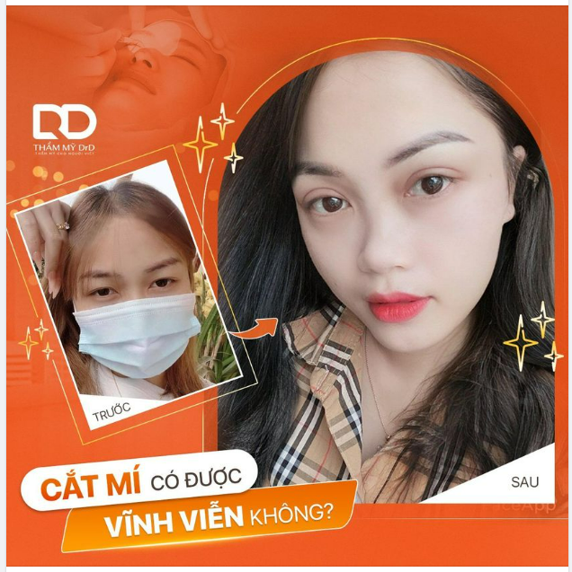 CẮT MÍ BAO LÂU PHẢI LÀM LẠI CÓ ĐƯỢC VĨNH VIỄN KHÔNG