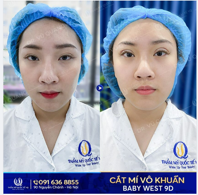 Cắt mí có tạo nên sự khác biệt