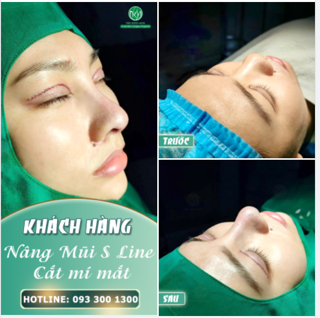 CẮT MÍ + NÂNG MŨI - COMBO TRẺ HÓA KHUÔN MẶT TOÀN DIỆN