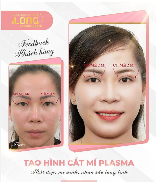 CẮT MÍ PLASMA - VUI LỄ THẢ GA