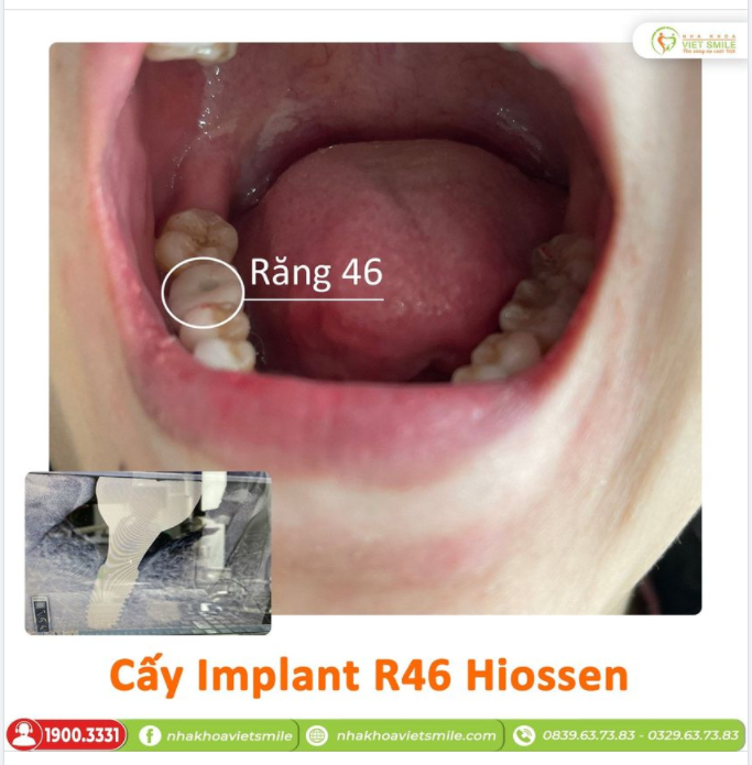 CẤY GHÉP IMPLANT HIOSSEN RĂNG 46 - ĂN NHAI CHẮC KHỎE