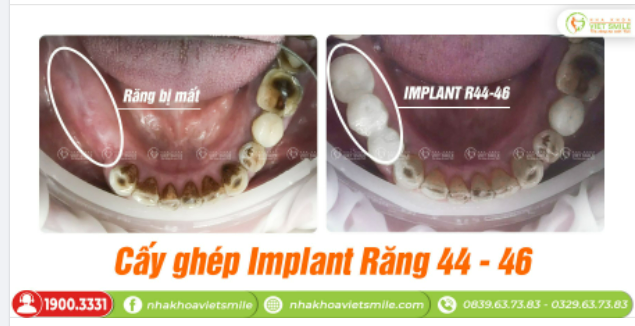 CẤY IMPLANT RĂNG 44-46 - PHỤC HÌNH RĂNG MẤT, ĂN NHAI THOẢI MÁI