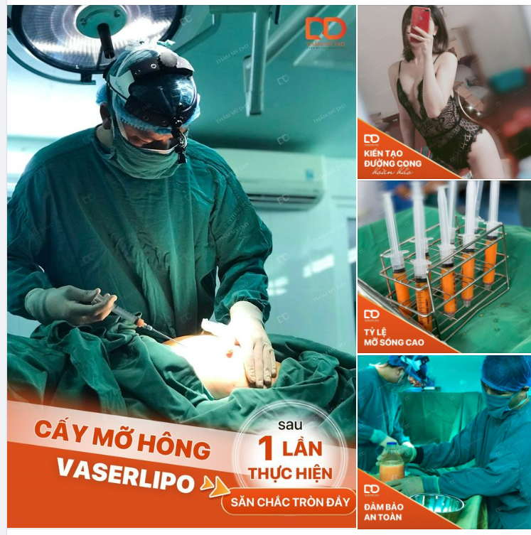 CẤY MỠ HÔNG ĐIÊU KHẮC CƠ THỂ HOÀN HẢO NHƯNG LIỆU CÓ AN TOÀN