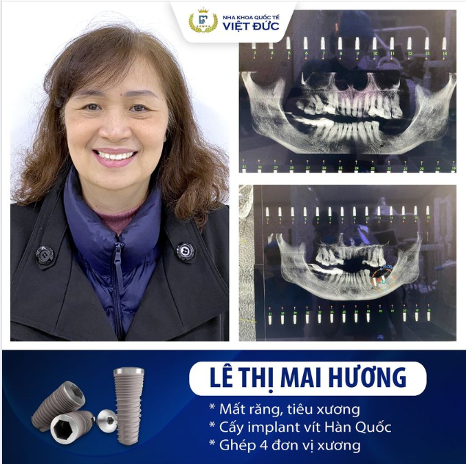 CHẤM DỨT VIỆC ĂN UỐNG KHÓ KHĂN NHỜ TRỒNG RĂNG IMPLANT