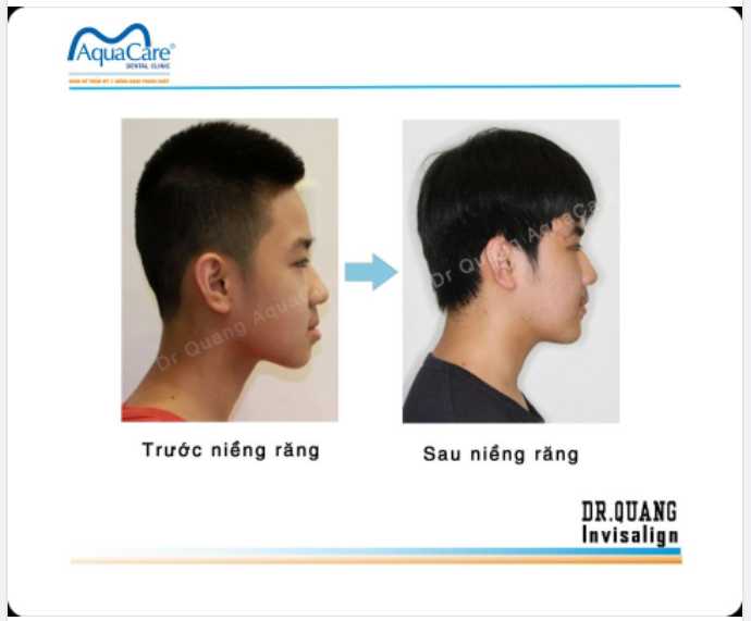 CHÀNG TRAI HIỆN ĐẠI LÀ KHÔNG NGẠI NIỀNG RĂNG! 