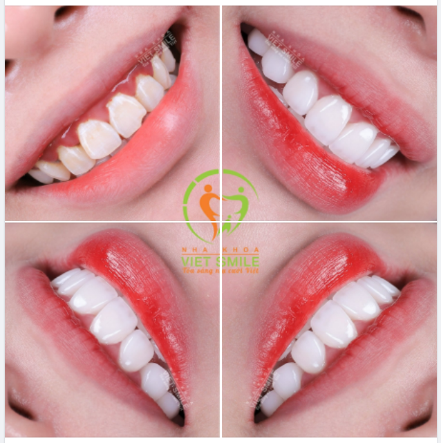 CHÀO ĐÓN NỤ CƯỜI MỚI, RẠNG RỠ HƠN - TẠM BIỆT RĂNG MẺ, Ố VÀNG