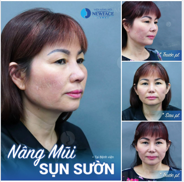 Chị ấy đã từng nâng mũi làm đẹp nhưng bị lộ sống, nhọn đầu mũi.
