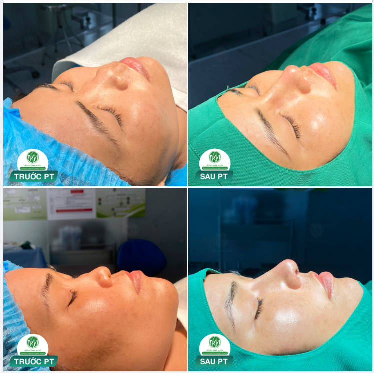 Chỉ cần có mũi đẹp, xa cách mấy em cũng đi... - Tâm sự của một khách hàng từ Cà Mau không ngại đường xa lên Bệnh viện để nâng mũi.