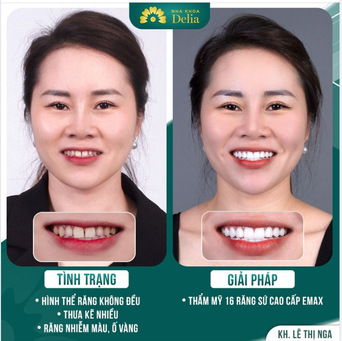 Chị chia sẻ: ""Mình là người cực kì khó tính, nhưng mình KHÔNG thất vọng khi đã tin tưởng bác sĩ tại Delia! Không chỉ đẹp mà khả năng nhai cũng tốt hơn cả răng thật.""