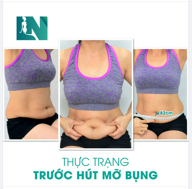 CHỊ KH (47 TUỔI) BAY NỬA VÒNG TRÁI ĐẤT VỀ VIỆT NAM THỰC HIỆN HÚT MỠ TẠO DÁNG THẨM MỸ 