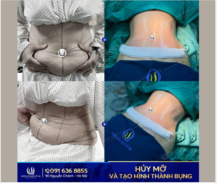 Chị KH cũng giống rất nhiều bà mẹ tìm đến với bác sĩ Vũ Quang mất hoàn toàn đường cong cơ thể sau khi sinh 2 bé