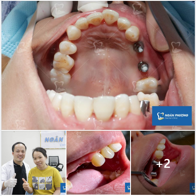 Chị khách đến với nha khoa Ngân Phượng trong tình trạng mất 2 răng 4,5 hàm trên.