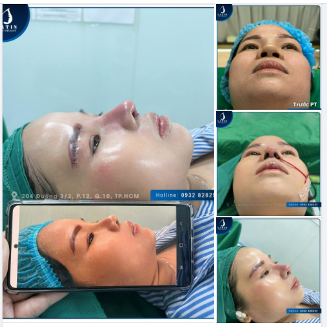 Chị khách làm combo môi + mũi + mày