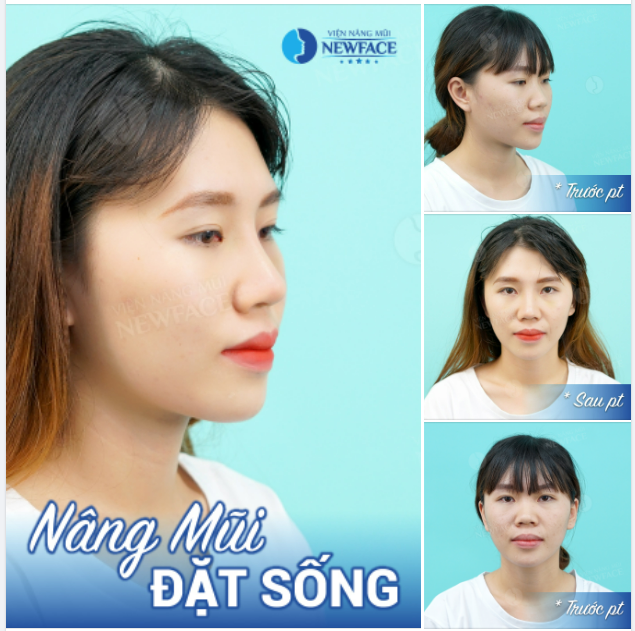 Chi Phí Nhẹ Nhàng + An toàn = Nâng mũi đặt sống