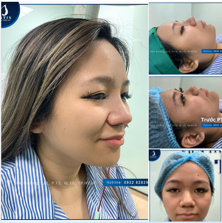 Chiếc mũi siêu ưng ý cho chị khách bay về từ Mỹ