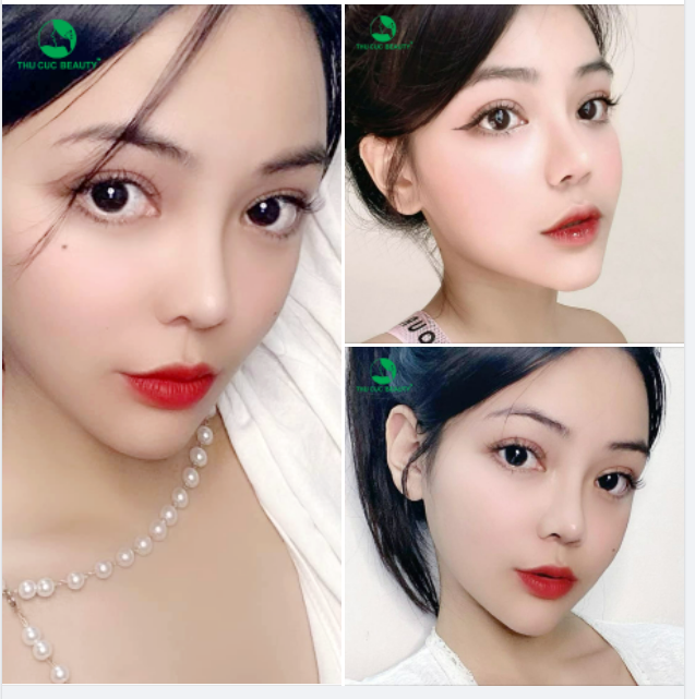 Chiêm ngưỡng đôi mắt 2 mí sâu tây sau khi thực hiện CẮT MÍ TC tại Thu Cúc