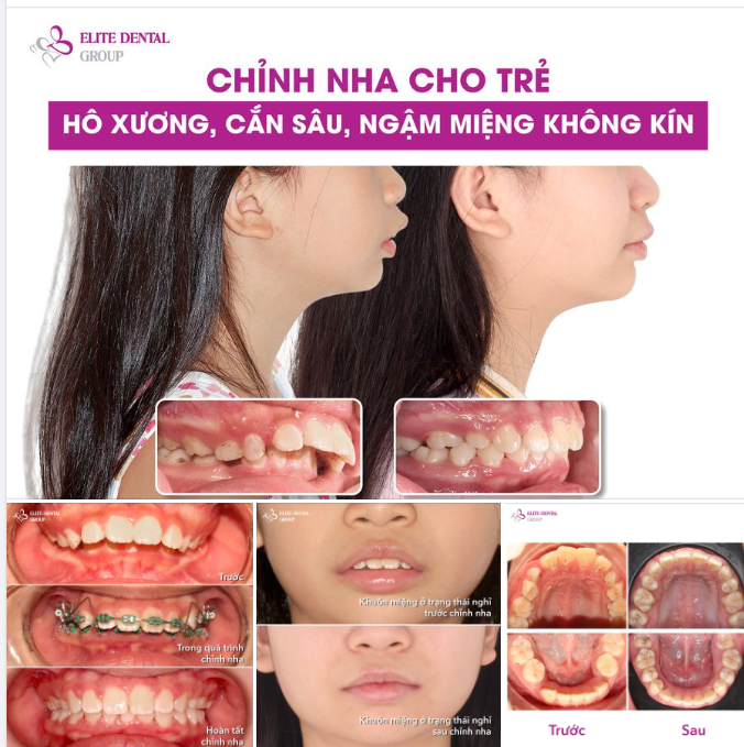 CHỈNH NHA CHO TRẺ HÔ XƯƠNG, CẮN SÂU, NGẬM MIỆNG KHÔNG KÍN