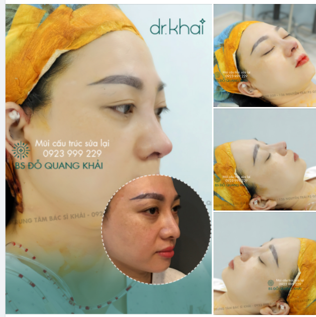 CHỈNH SỬA DÁNG MŨI HỎNG, LỘ SỤN ĐẦU MŨI TẠI TRUNG TÂM BÁC SĨ KHẢI