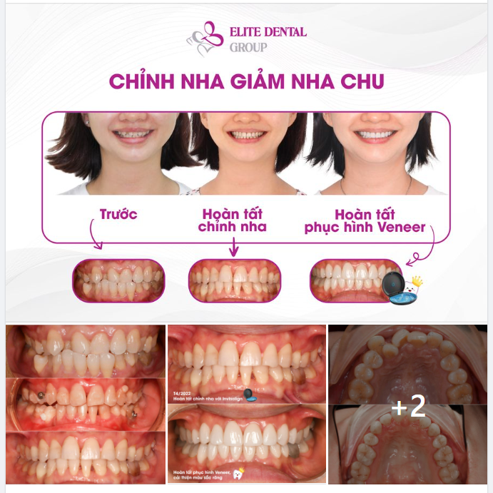 CHỮA LÀNH NHA CHU VỚI CHỈNH NHA