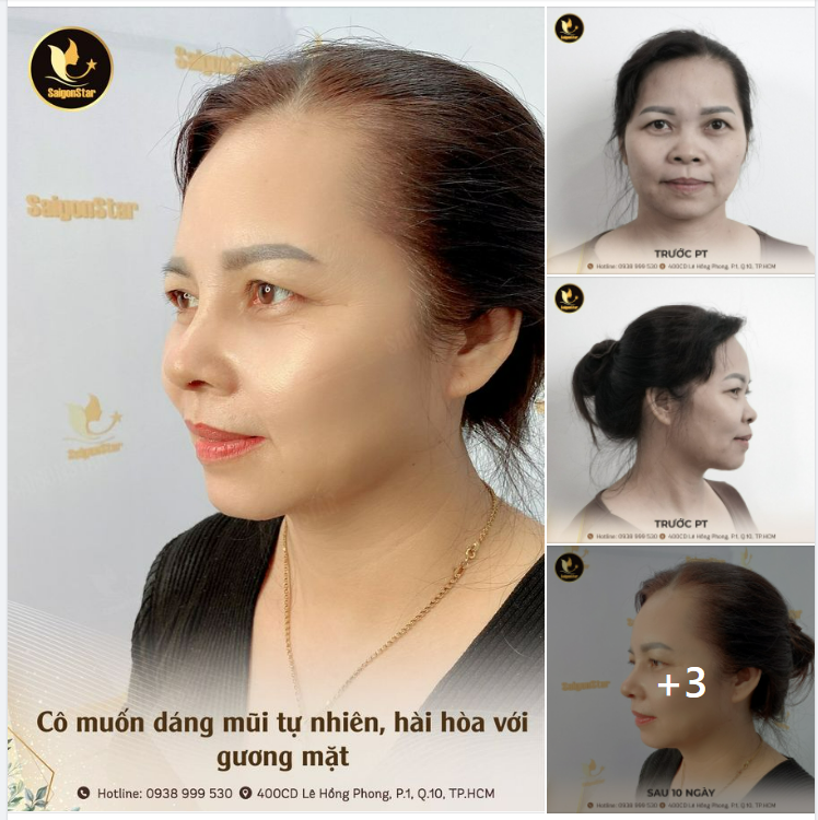 CÔ MUỐN DÁNG MŨI TỰ NHIÊN, HÀI HOÀ VỚI GƯƠNG MẶT