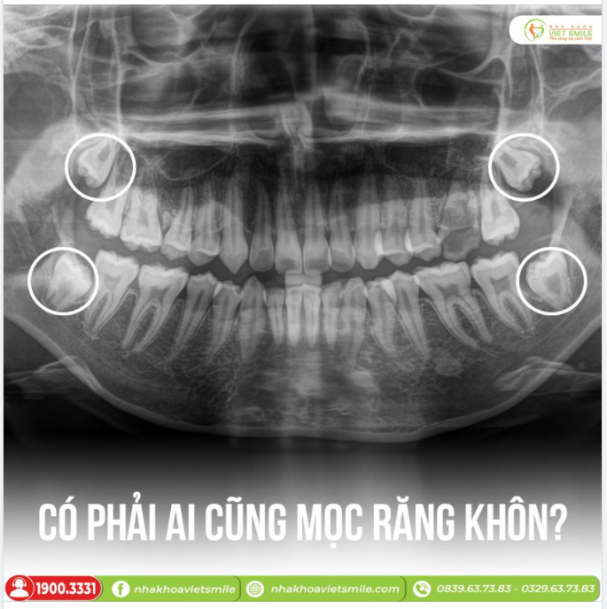 CÓ PHẢI AI CŨNG MỌC RĂNG KHÔN?