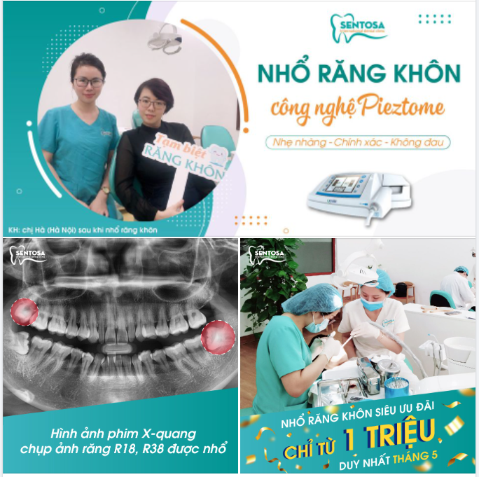 Có Piezotome ngại gì răng khôn?