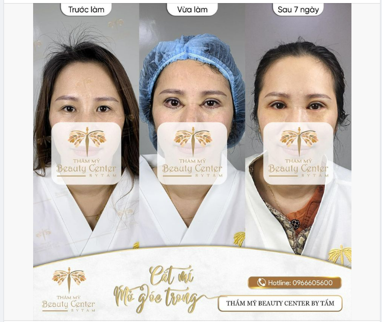Combo Cắt mí - Mở góc trong Perfect Eyes. Mới 7 ngày mà đã thế này thì có đẹp quá mức quy định không ạ