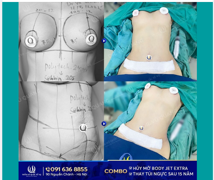 Combo ĐẶC BIỆT  Hủy mỡ V2 Body Jet Extra ​​​​​​​ Thay túi ng ực sau 15 năm.